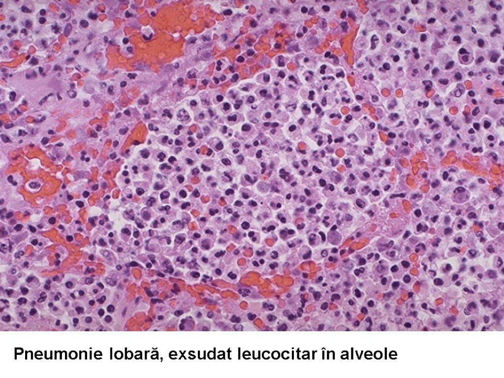 Pneumonie lobară, exsudat leucocitar în alveole